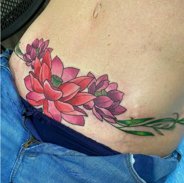 Tummy Tuck Tattoo with Lotus Flower